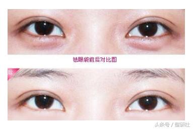 无痕去眼袋案例分享,微创无痕去眼袋