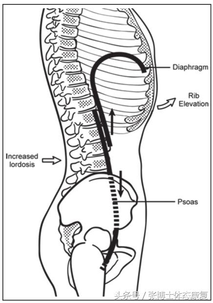 吹气球脊柱侧弯康复,吹气球减腰椎视频