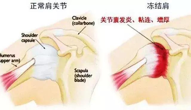 肩疼膀子疼去医院挂什么科,颈椎疼和肩疼会引起其它什么病