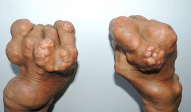 痛风食谱最不能吃的肉菜,痛风患者的一日三餐食谱大全