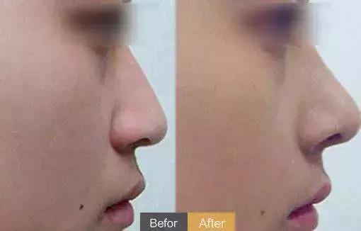 假体隆鼻都有什么术式,假体隆鼻一般用什么材料