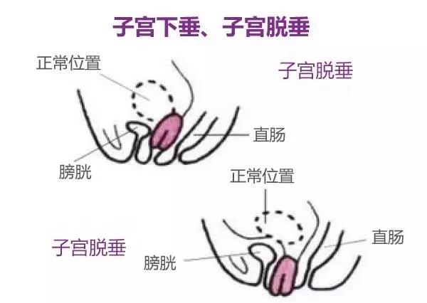 顺产盆底康复神器,只有顺产骨盆才会变宽吗