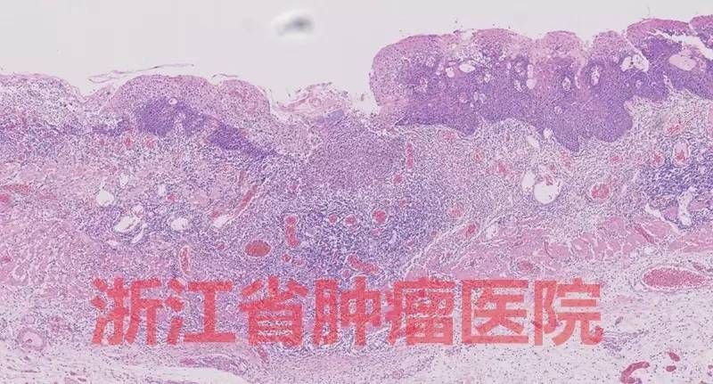 食管大面积黏膜病变,看看这家医院如何处理?!