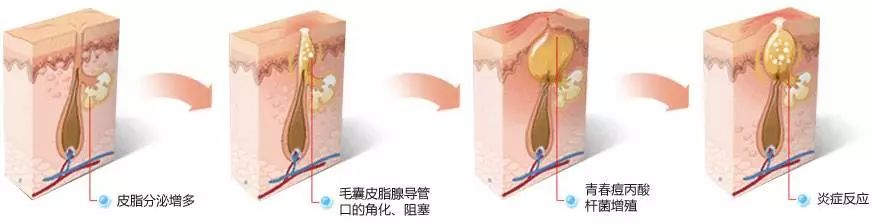 祛痘药膏不能乱用,祛痘药膏用之前能用护肤品吗