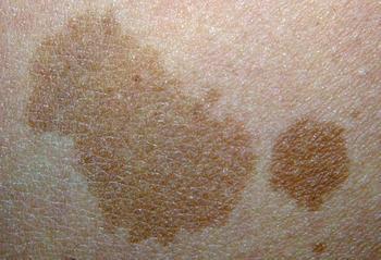 咖啡斑的最佳治疗时间是什么,咖啡斑的发病率高吗