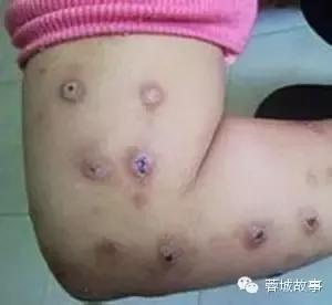 湿疹痒痒如何缓解,湿疹痒痒处能拍打么