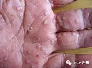 湿疹痒痒如何缓解,湿疹痒痒处能拍打么