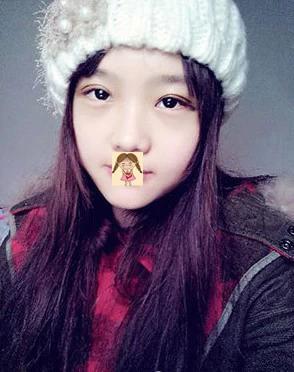 埋线双眼皮去掉线能恢复原样吗,纳米无痕双眼皮埋线怎么恢复得快