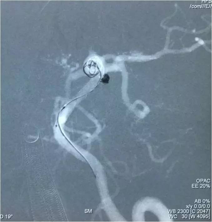 基底动脉顶端动脉瘤加左侧小脑上动脉瘤以Y型支架结合弹簧圈栓塞