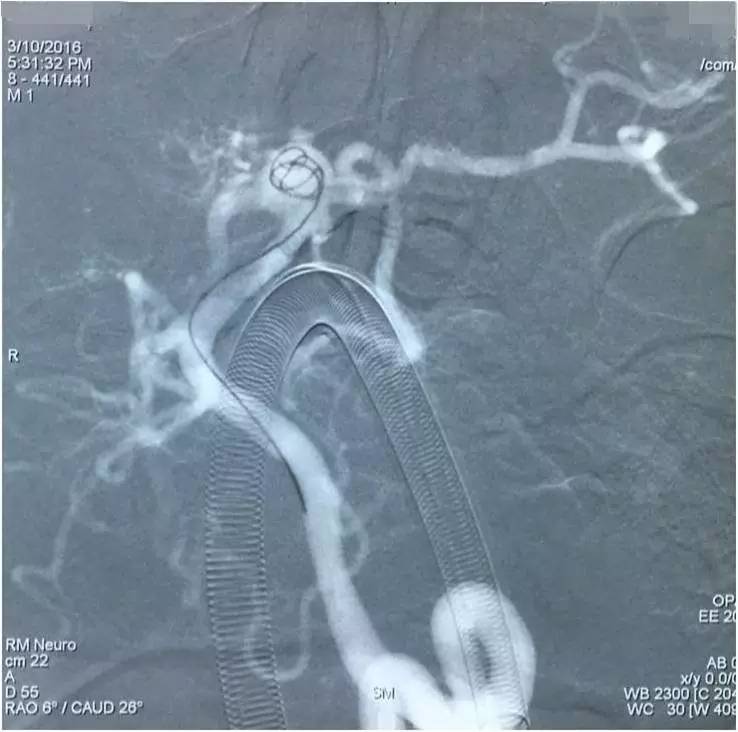 基底动脉顶端动脉瘤加左侧小脑上动脉瘤以Y型支架结合弹簧圈栓塞