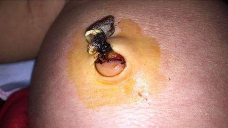 如何预防宝宝败血症,妈妈不可忽视宝宝这些行为