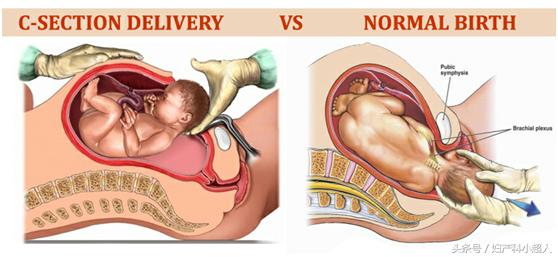 二次剖宫产宫缩痛多久,如果第一胎是剖第二胎顺产会快吗