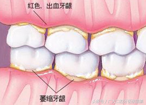 牙槽骨萎缩是什么症状,牙齿太久不咀嚼会牙槽骨萎缩吗
