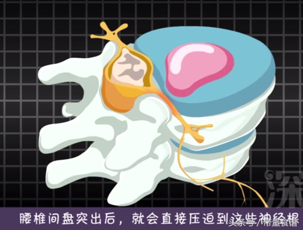 坐不久就腰痛怎么回事,坐着的时候腰椎间盘突出