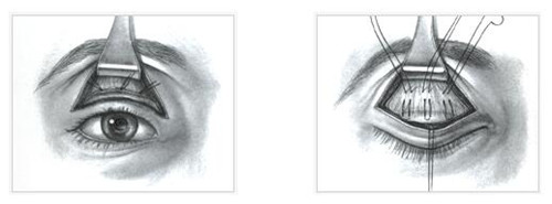 二次修复双眼皮恢复过程,二次修复双眼皮的过程