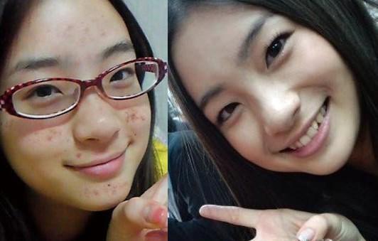 混油敏痘肌用什么护肤品,痘印痘坑最佳解决方案