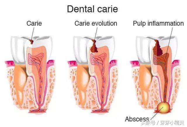 牙龈处长了不疼的小包,牙龈上起了一个小肉包的图片
