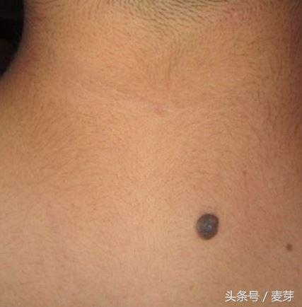 黑痣用针挑了会留疤吗,长黑痣用什么药去掉