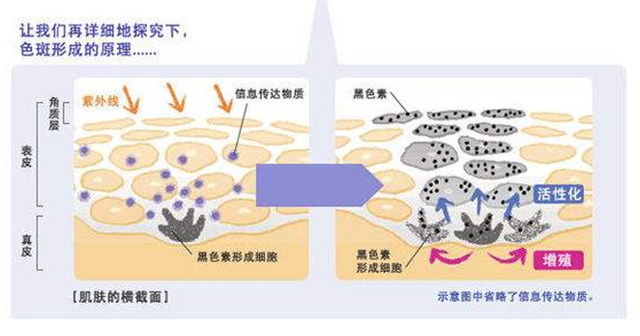 点的雀斑留色素了怎么办,表皮雀斑怎么去除