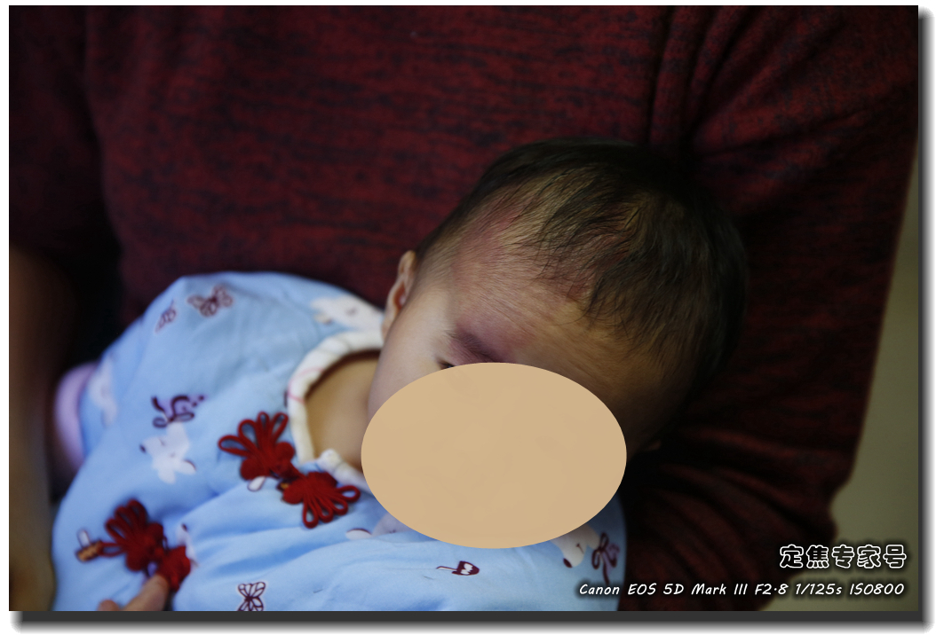 皮肤专家诊室故事连载之四，胳膊上一个小硬块能掏出多少东西？