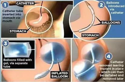 黑科技减肥全过程,黑科技减肥对身体有害处吗