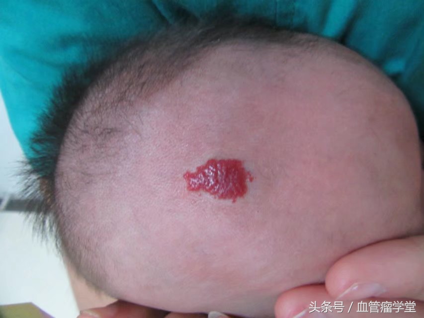 治疗血管瘤的药物普萘洛尔,普萘洛尔治疗血管瘤的剂量及方法