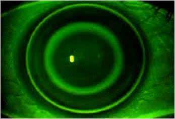 近视眼100度可以矫正吗,眼睛近视还有矫正的必要吗