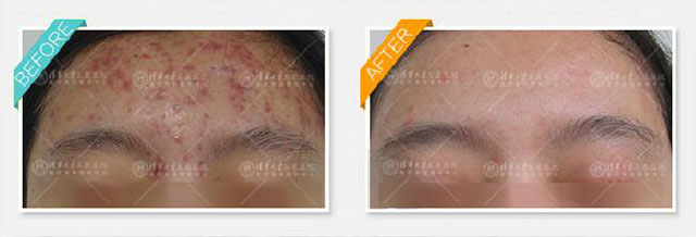 青春痘有什么方法解决,青春期已经长痘了怎么改善皮肤