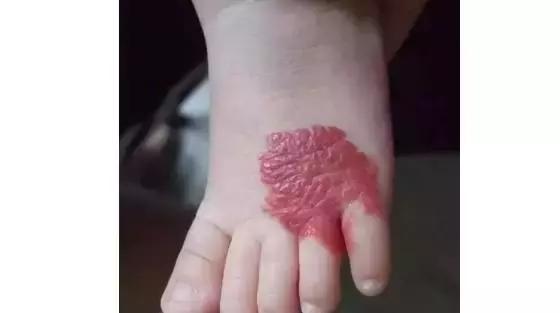 宝宝身上隐藏的“胎记”，你或许还没有发现