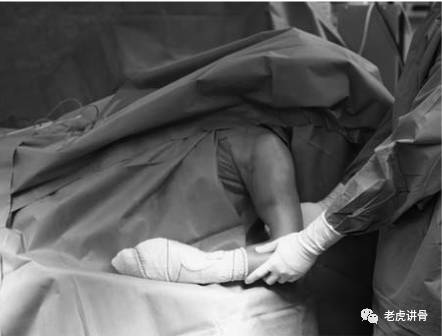 肱骨骨折髓内钉手术全过程,肱骨近端骨折髓内钉的治疗方案