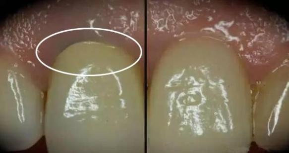 细说烤瓷牙的那些事,一篇文章让你充分了解烤瓷牙