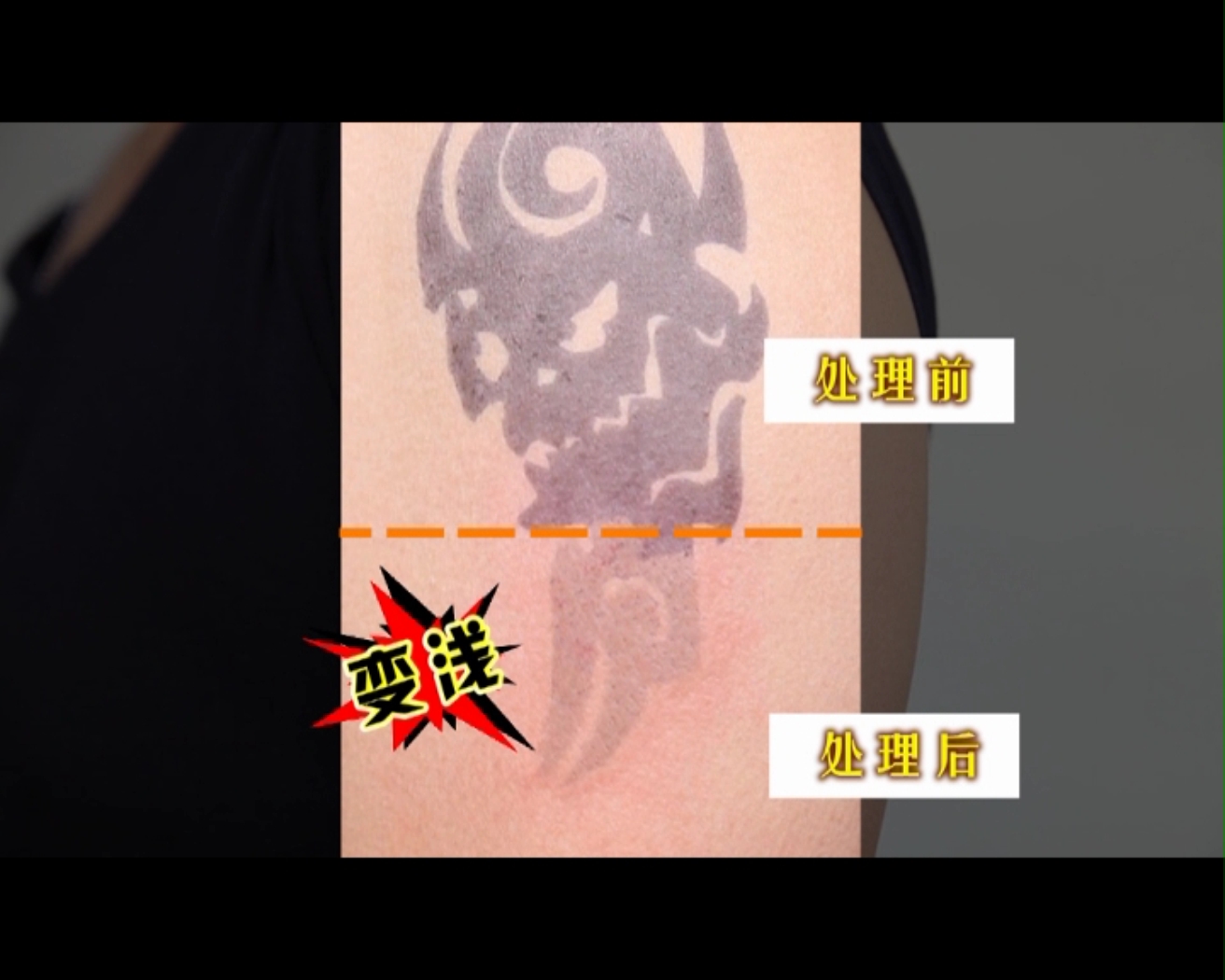 去除纹身激光得花多少钱,激光去除纹身的原理