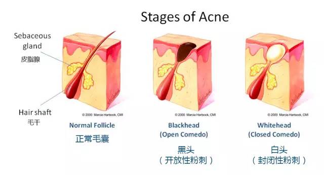 脸上反复起脓包黑头粉刺怎么回事,四十岁了脸上还有黑头粉刺怎么办