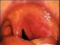 扁桃体化脓痛苦,扁桃体周围脓肿最常见的症状