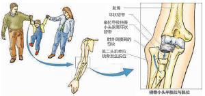 孩子爸爸拽孩子胳膊,爸爸拽孩子脱臼