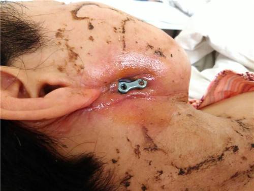 骨髓炎反反复复七年了怎么治疗,下颌骨骨髓炎手术后半年复发