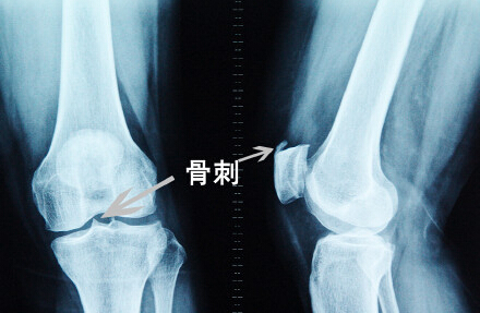膝关节骨刺的表现症状,膝关节骨刺的症状