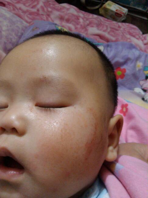 小孩子皮肤干裂怎么办,小孩冬天皮肤干裂用什么护肤品