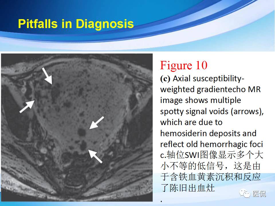 双语PPT：子宫腺肌症常见和不常见的MRI表现医学影像