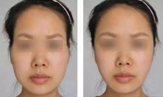 自体脂肪填充过来人的感受,自体脂肪全脸填充移位至颧骨