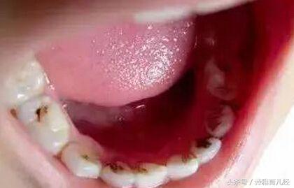 宝宝牙齿上有黑点是蛀牙吗,宝宝牙齿上有小黑点是蛀牙吗