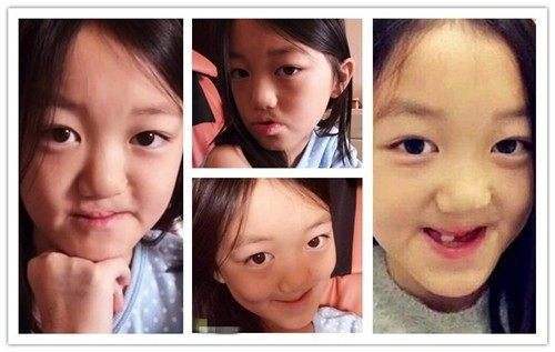 李嫣先天兔唇,天生唇腭裂的李嫣