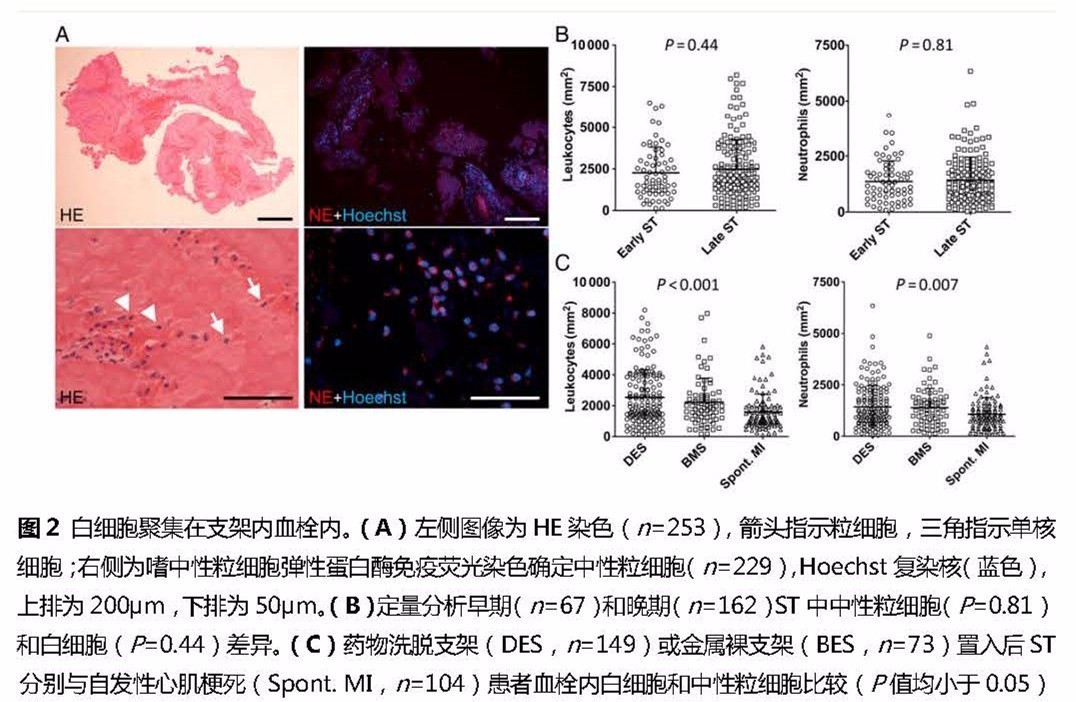 支架内血栓怎么处理,支架内血栓的原因及表现