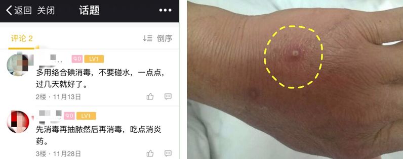 穿刺导致血液细菌感染怎么办,输液港穿刺点感染的原因