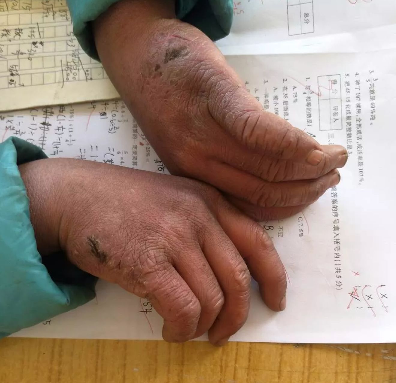 冻疮怎么消除才能彻底好,冻疮怎么预防除根