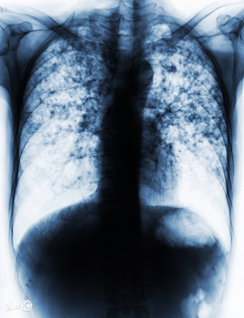 风湿病与结核病哪个严重,风湿的病人要怎么治疗