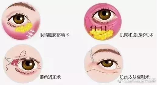 眼部整形常见的15个问题,眼部护理要避开九大误区