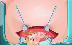 原来剖腹产的危害这么多！你都知道吗？谨慎