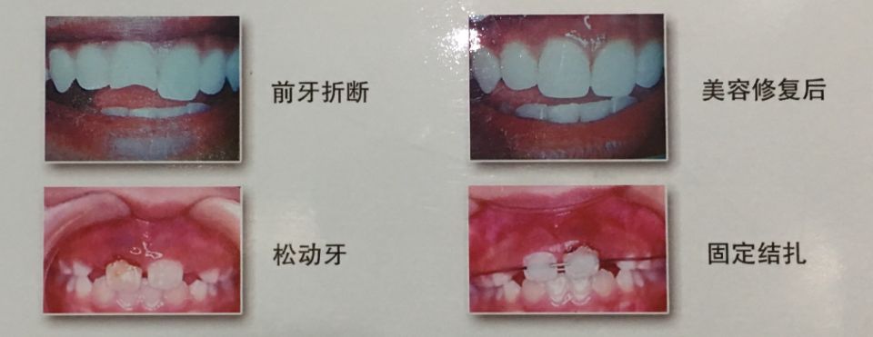 牙齿摔坏到什么程度需要根管治疗,牙齿摔坏吃什么