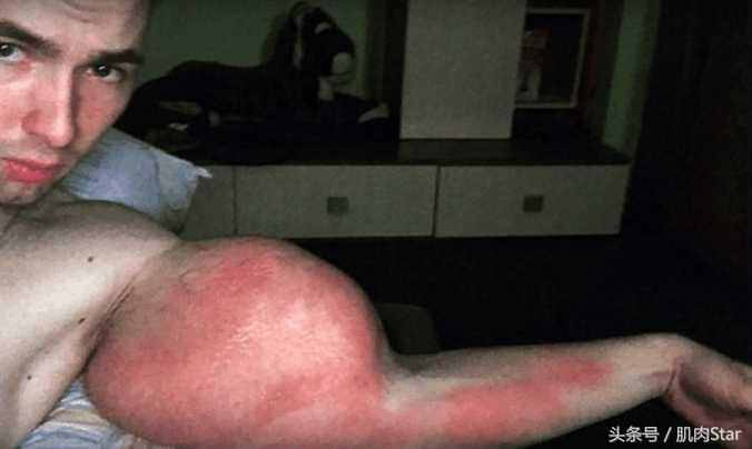 俄罗斯男子肌肉注射,25岁小伙健身3天被溶解